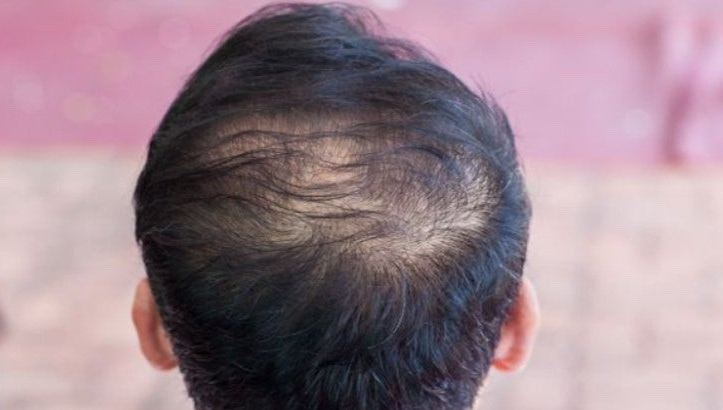 두피 타입별 맞춤 탈모샴푸 관련 사진