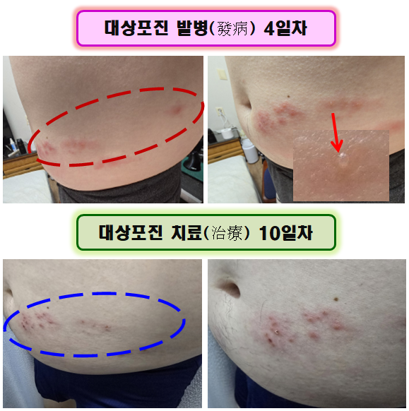 대상포진 발병 4일차, 대상포진 치료 10일차