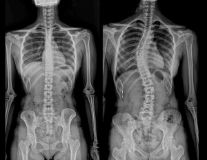 척추측만증-진행과정-x-ray