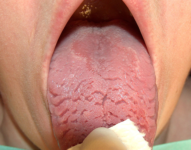 혓바닥 갈라짐의 주요 원인