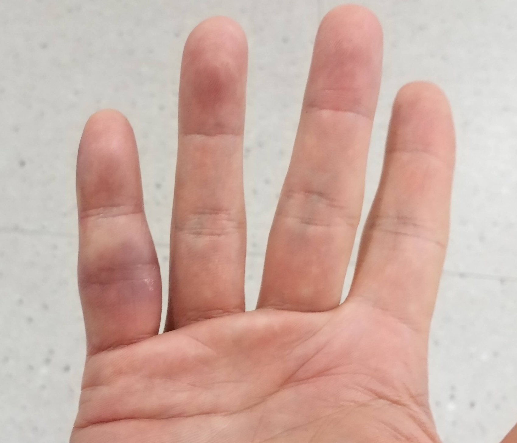 2월8일부은손가락상태1