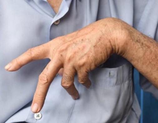 근위축성 측색경화증 ALS