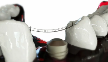 임플란트 종류와 선택 방법