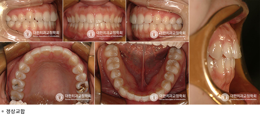 윗니와 아랫니의 교합
