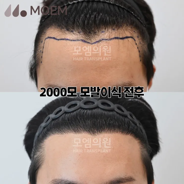 머리카락 이식 3000모 3000모낭 비용과 시술 과정_5