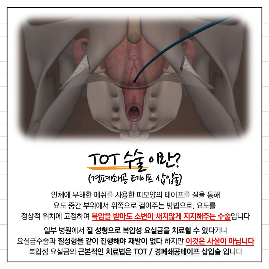 TOT수술이란?