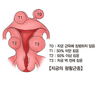 자궁근종 증상