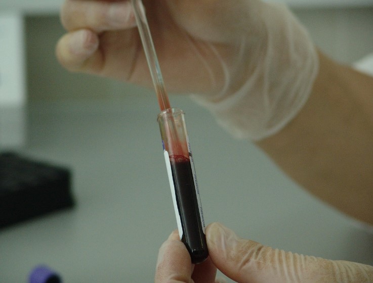 탈모 병원 치료