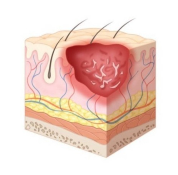 2단계 - 부분층 피부 손실