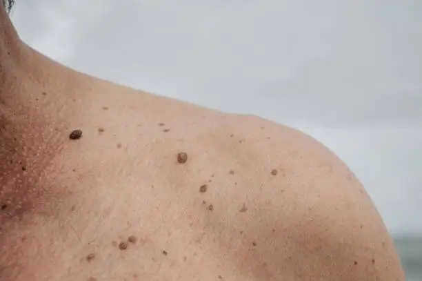 주근깨 없애는 방법