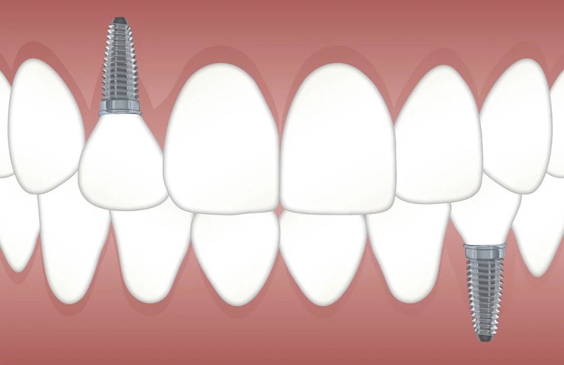 65세이상 임플란트 건강보험