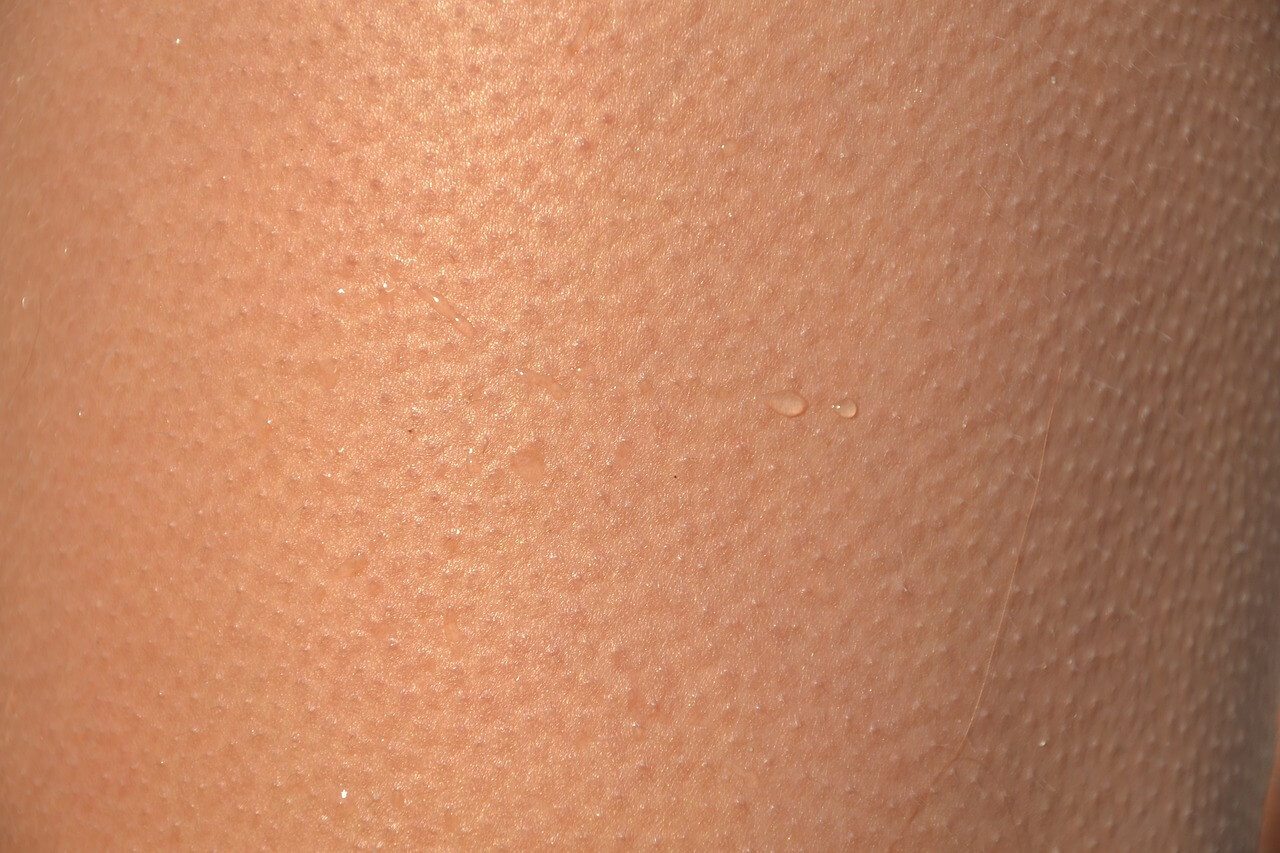 모공각화증-닭살