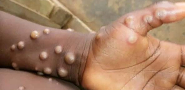 원숭이두창 증상