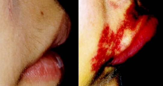 신경치료의 부작용인 NaOCl accident