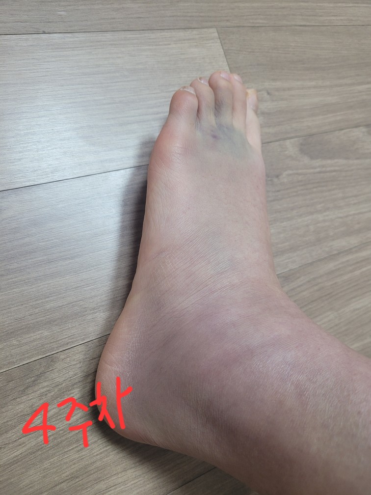 발목-접질렀을-때