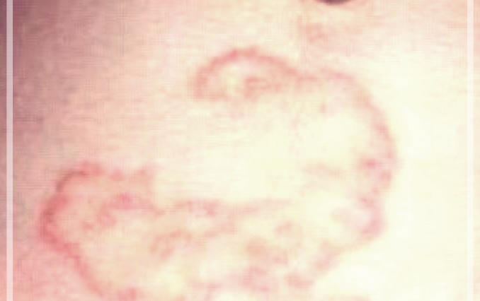 체부백선: 이해, 치료법, 그리고 관리