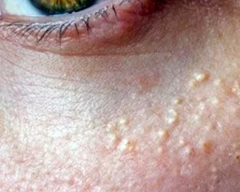 비립종 생기는 이유 비립종 없애는 방법 피부 관리법_11