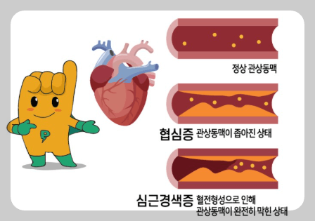 신근경색