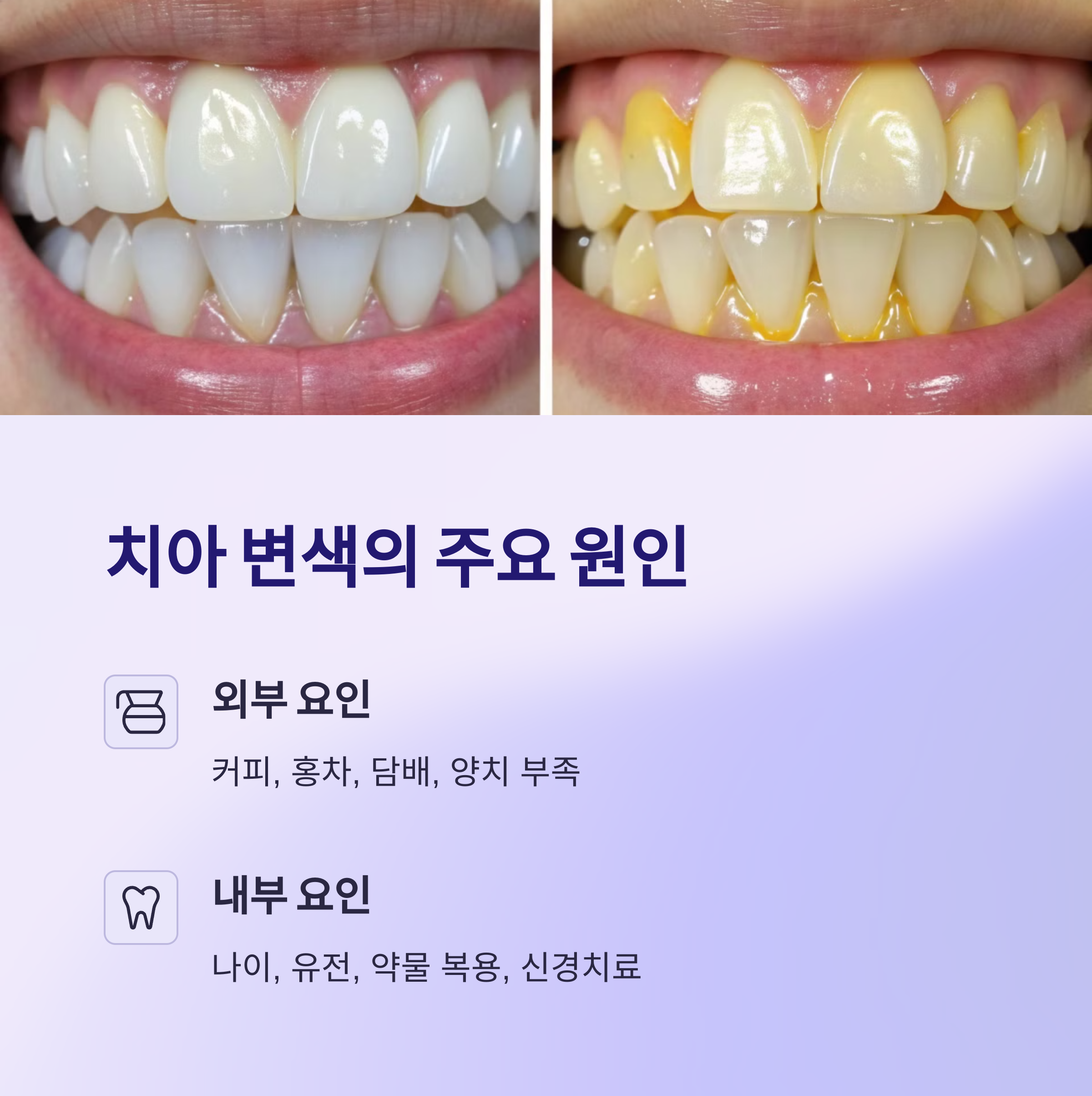 치아 변색의 주요 원인
