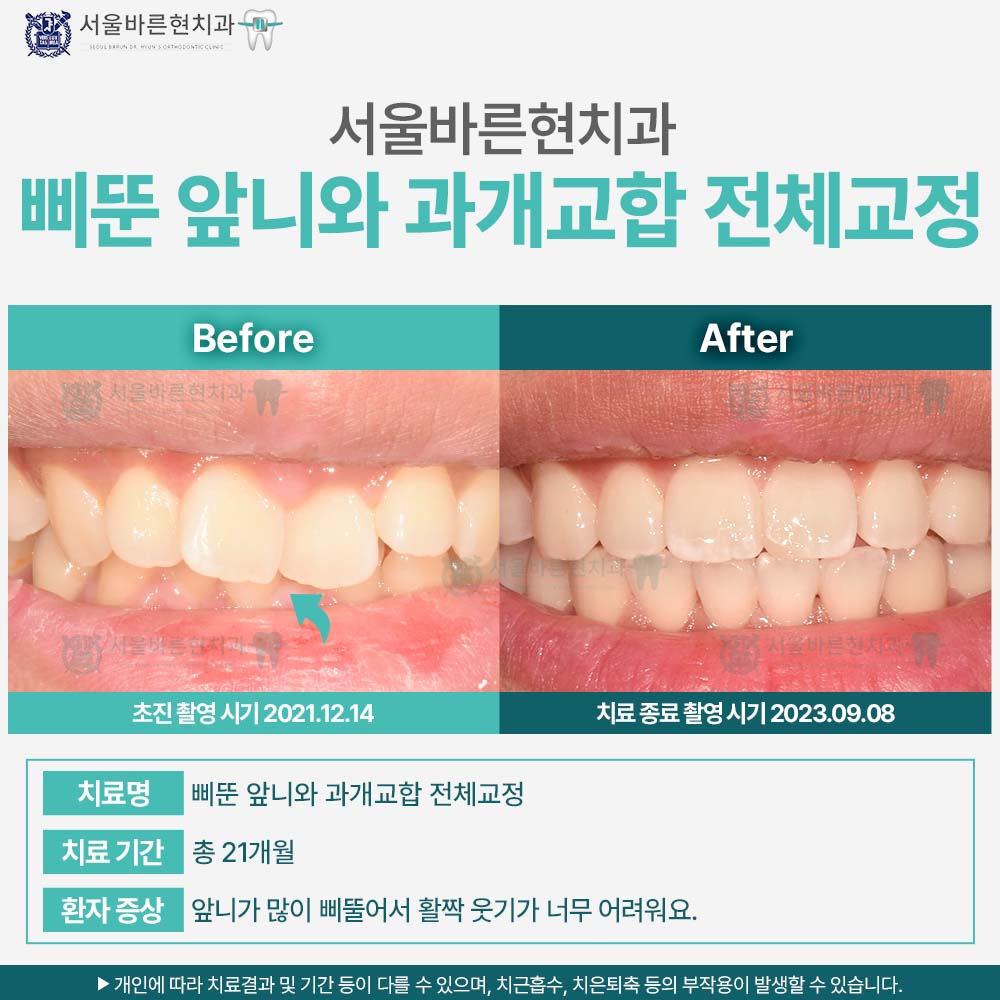 해운대치아교정