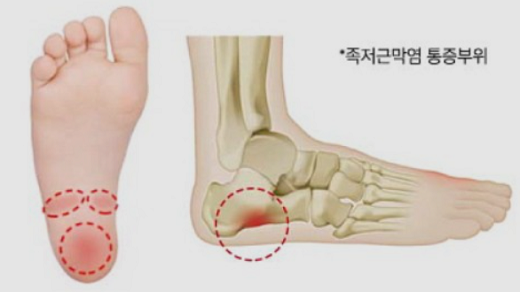 족저근막염