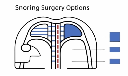 코골이수술 과정