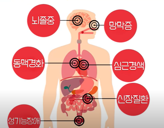 고혈압 합병증