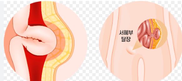 탈장 수술 비용 및 탈장 입원기간 총정리