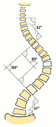 cobb angle
