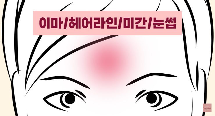 여드름 부위별 원인 이마 헤어라인 미간 눈썹