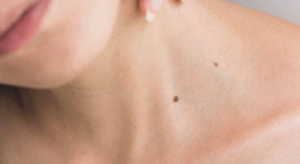 쥐젖이 생기는 이유, 쥐젖 제거방법