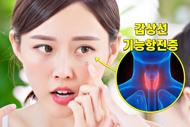 실명 전조증상 5, 갑상선 기능 항진증 사시 눈돌출, 팁줌