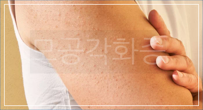 팔 모공각화증