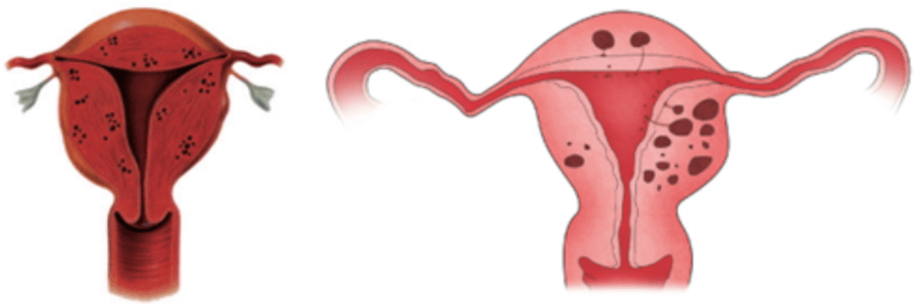 자궁근종-자궁선근증