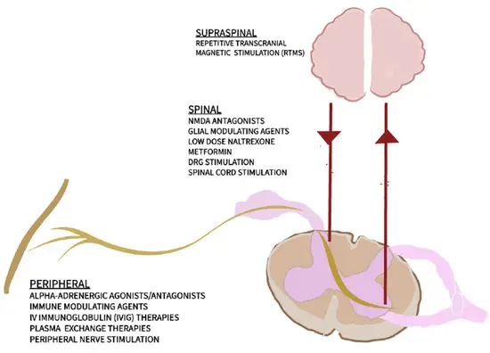 복합부위통증증후군(CRPS)의 최신 진단 및 치료법: 맞춤형 CRPS 관리를 위한 종합적 접근