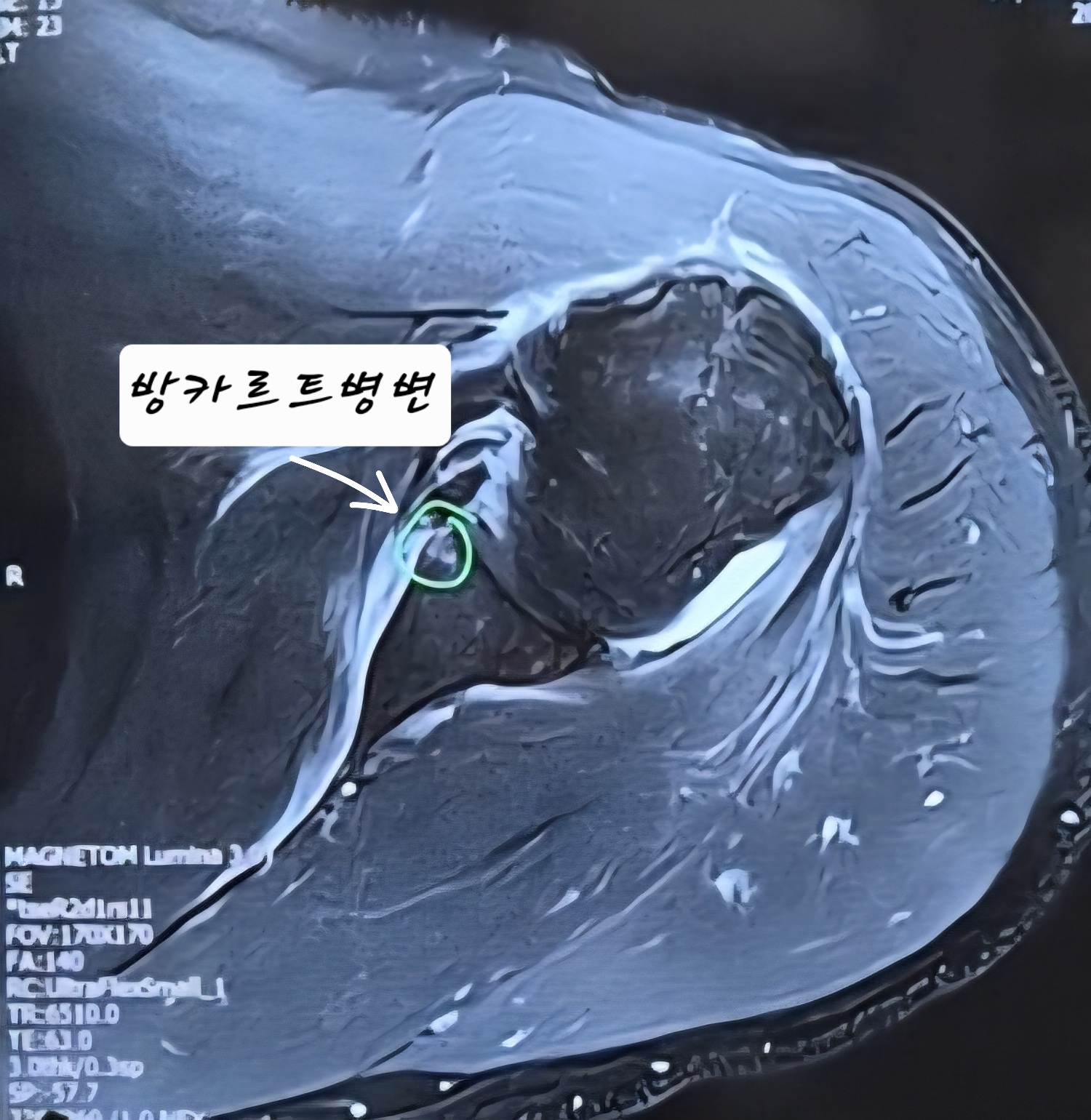 덤벨 풀오버 수행 중 어깨 탈구로 방카르트 힐삭스 병변 진단