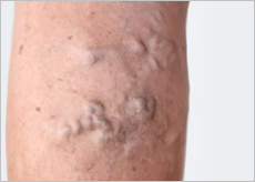 하지정맥류 증상 이미지