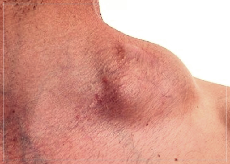 호지킨림프종과 비호지킨림프종: 이해, 진단, 그리고 치료