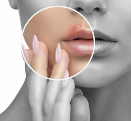 입술에 물집이 생기는 이유 31