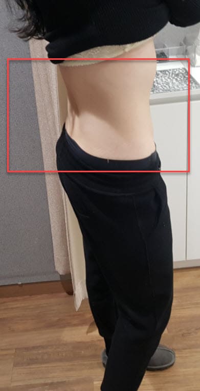 뱃살 지방흡입 후기