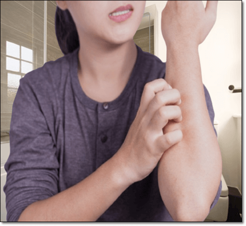 망고 알레르기 여성