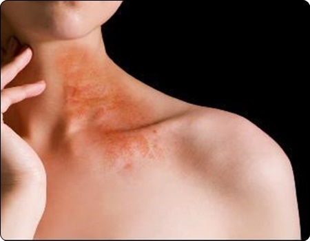 대상포진 예방접종 가격