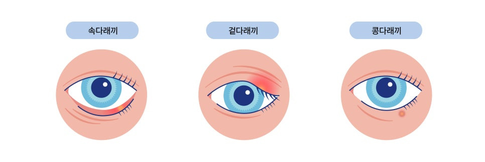 눈다래끼 빨리 낫는 법
