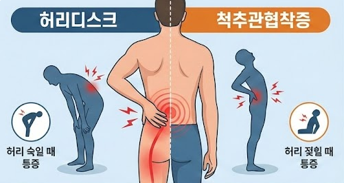 허리디스크 vs 척추관협착증