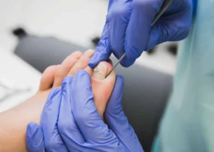 내향성 손발톱 원인, 상황별 적합한 치료법, 관리법