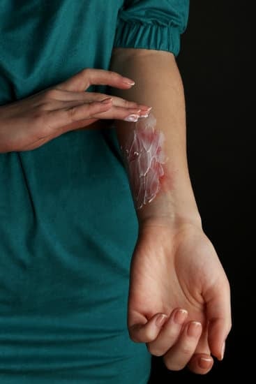 흉터 치료 연고