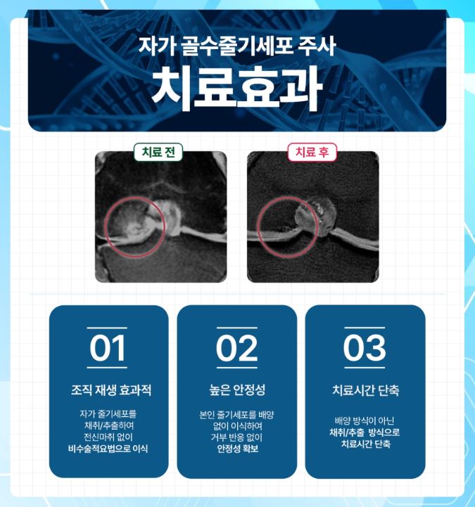 무릎줄기세포주사 가격 및 무릎줄기세포주사 실비 실손 보상 / 전국 병원추천