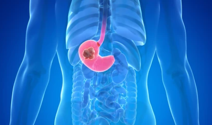 위암 3기 생존율