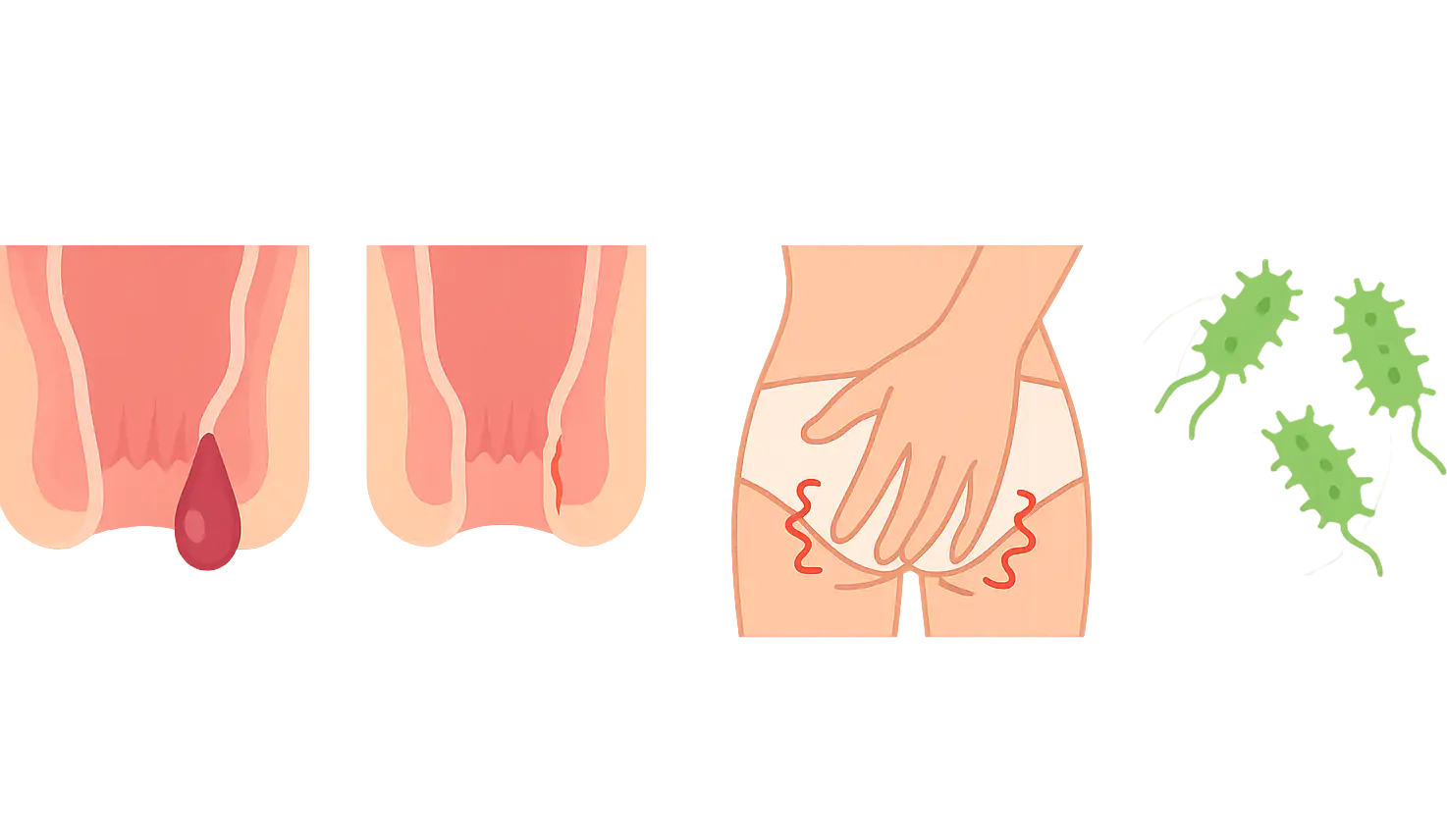 내치핵 돌출, 치열(찢어진 항문 피부), 가려움으로 긁는 손, 세균 감염 위험