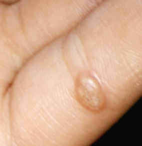 사마귀 원인과 제거방법